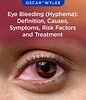 Eye Bleeding (Hyphema): Definition, Causes, Symptoms, Risk Factor and ...