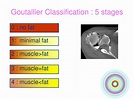 PPT - IRREPARABLE ROTATOR CUFF TEAR PowerPoint Presentation, free ...