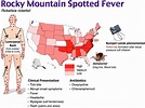 25 Rocky Mountain Spotted Fever Map - Maps Online For You