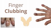 Finger Clubbing - Introduction, Pathophysiology & Causes - Mnemonic to ...