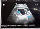 [懷孕] 16週超音波怎麼看男女呢 🔥 BabyMother板
