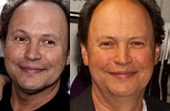 Billy Crystal Facelift Plastic Surgery Before and After | Celebie