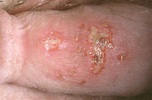 herpes simplex virus type 2 pictures - pictures, photos