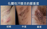 腋下胯下爆痘 流膿有異味 | 中華日報|中華新聞雲