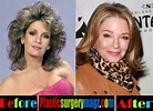 Deidre Hall Plastic Surgery Before and After Photos | | Plastic Surgery ...