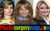 Deidre Hall Plastic Surgery Before and After Photos | Plastic Surgery ...