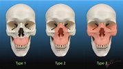 LeFort Classification of Facial Fractures | UW Emergency Radiology