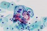 Cytopathology: Pathology – UT Southwestern, Dallas, Texas