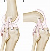 Figure 1 from Anatomy of the anterolateral ligament of the knee ...