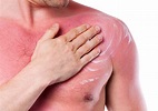 Infalibles: Consejos para aclarar la piel quemada por el sol - Porlavisión