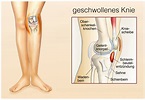 Flüssigkeit im Knie – Heilpraxis