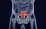 Assessing the Hope and Hype of Precision Medicine for Colorectal Cancer ...