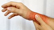Wrist Arthritis: Educational Guide | Ladan Hajipour Wrist and Hand Surgeon