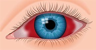 What causes blood in your eyes (subconjunctival hemorrhages ...
