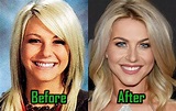 Julianne Hough Plastic Surgery: Nose Job and Botox? Before After ...