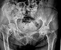 Fracturas de cadera - Centro de Diagnóstico por Imágenes Linda Vista