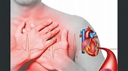 Infarto del miocardio: Tratamientos modernos | La Prensa Gráfica