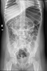 Figura 1. Radiografía simple de abdomen que muestra una distensión ...