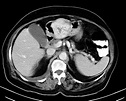 Gastric adenocarcinoma | Radiology Reference Article | Radiopaedia.org