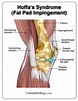 Hoffas Syndrome - Fat Pad Impingement Knee