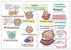 Acute Respiratory Distress Syndrome (ARDS) - Creative Med Doses