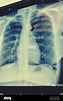 A lungs radiography image scan. x-ray film chest or lung of patient for ...