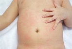 Heat Rash On Baby Causes And Treatment Bellybelly - Riset