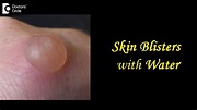 Skin Blisters with Water: Causes, Treatment, Draining, Prevention - Dr ...