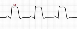 The ST Segment | ECG Basics - MedSchool