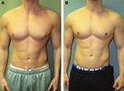 image idea coloring: Bodybuilder Gynecomastia Surgery Before And After