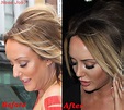 Charlotte Crosby Nose Job Plastic Surgery Before And After