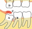 Wisdom tooth - Wikipedia