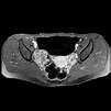 Krukenberg tumors of ovaries - Body MR Case Studies - CTisus CT Scanning