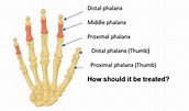 Hand Therapy - Phalangeal fractures of the fingers or thumb | Hull ...