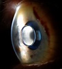 Telescopic Eye Implant Beats Macular Degeneration By Directing Light ...