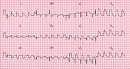 What is a tombstone on ECG?