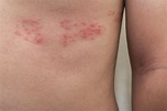 What is Shingles? - Beaumont Emergency Hospital