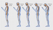 Text Neck Syndrome - Signs Symptoms and Solutions