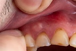 Doylestown Dental Abscess & Infection | 24/7 Emergency Care