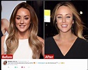 Charlotte Crosby has Rhinoplasty by Mr Sultan Hassan of Elite Surgical ...