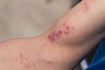 Shingles: What You Need to Know | The University of Vermont Health Network