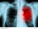 Lungeninfarkt – Ursachen, Symptome und Therapie