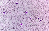 Blood Film under microscopic showing Microcytic Hypochromic Anemia ...