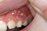 Dental abscess in a child - Stock Image - C008/3595 - Science Photo Library