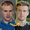 Rob Holding's Hair Transplant: Before and After Transformation