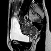 Krukenberg tumors of ovaries - Body MR Case Studies - CTisus CT Scanning