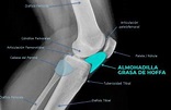 Dolor de rodilla | Hoffitis: lesión de la grasa de Hoffa - Sergio Sukunza