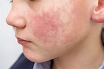 What You Need To Know About Scarlet Fever? - First Aid Pro Brisbane