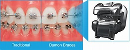 Damon System Bracket | Pasang kawat gigi Damon di Jogja