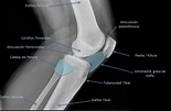 Importancia de la grasa de Hoffa en el dolor anterior de la rodilla ...